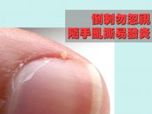 Hangnails 倒刺勿忽視  隨手亂撕易發炎