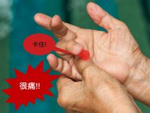 Trigger finger 手指彎曲就疼痛？ 你可能是患有「板機指」！1746068553