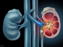 Kidney stone 營養師點名 4 類人易患腎結石1746068553
