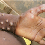 Monkeypox 猴痘 (粵語) 423 Monkeypox 猴痘 (粵語)